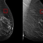 ذكاء اصطناعي جديد يتنبأ بسـ..ـرطان الثدي قبل خمس سنوات