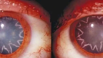 صدمة كهربائية بـ14 ألف فولت تؤدي لظهور نجمتين في عين عامل كهرباء