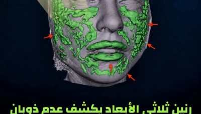حقن الفيلر لسنوات قد تغيّر ملامح الوجه.. ما قصة «الوجه الوسادي»؟