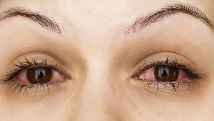 احذروا احمرار العين أثناء الاصابة بكورونا