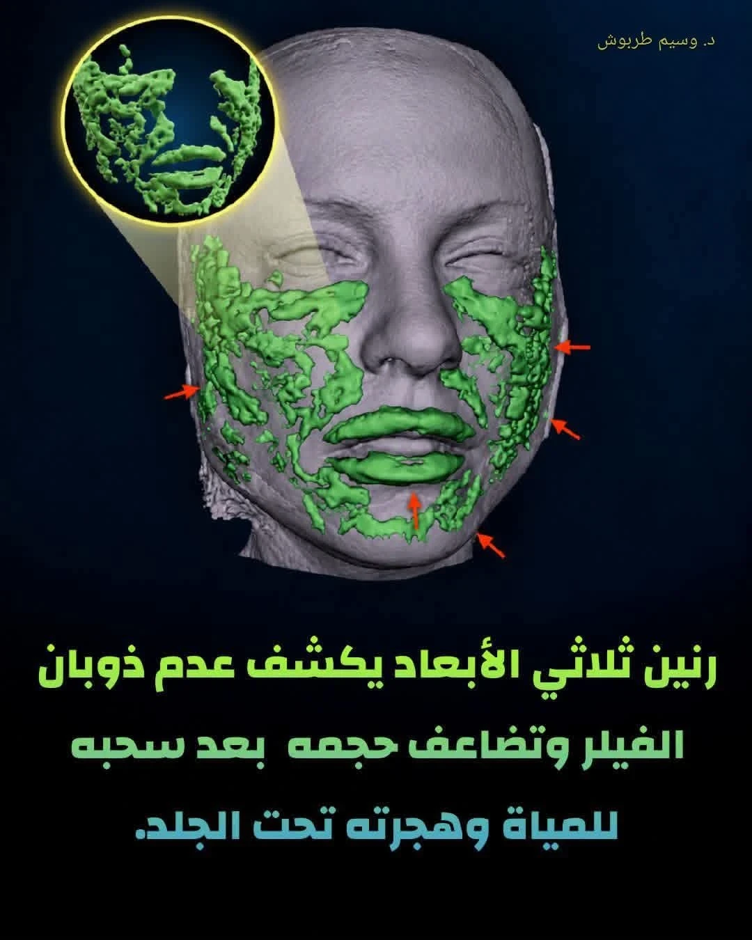 حقن الفيلر لسنوات قد تغيّر ملامح الوجه.. ما قصة «الوجه الوسادي»؟